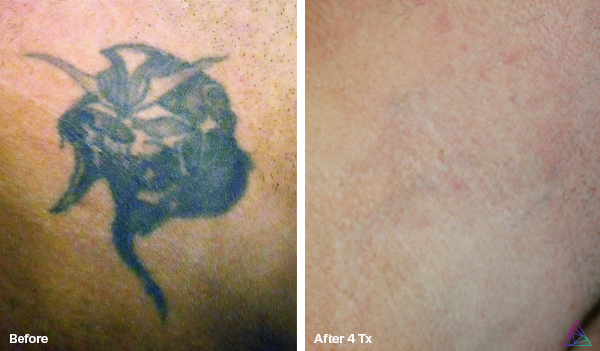 Before and after tattoo removal